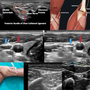 Workshop on Ultrasound of Peripheral Nerves : Upper Limb and Lower Limb